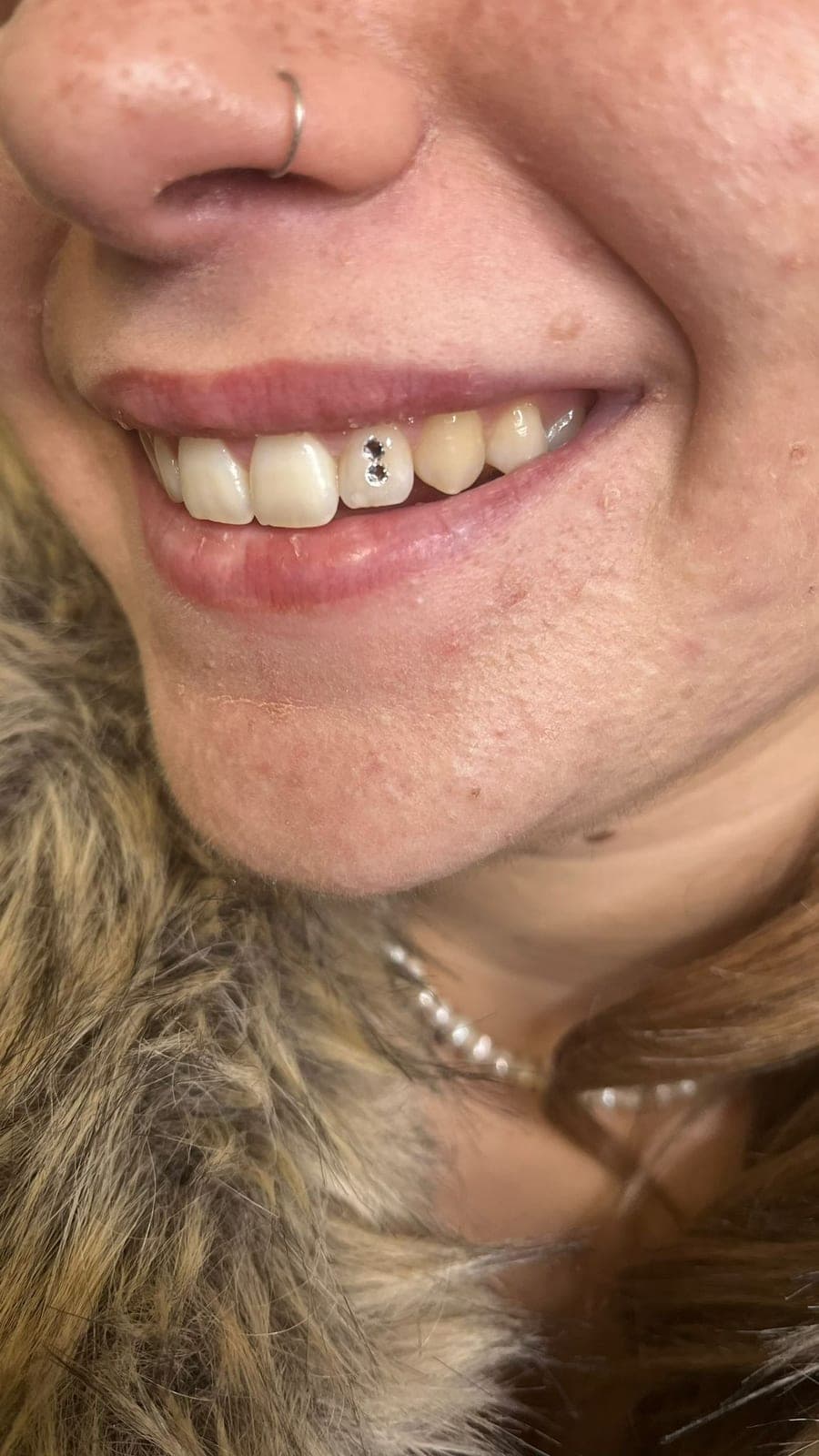 Tooth gem, brillantino sul dente — Golden Skin Bergamo