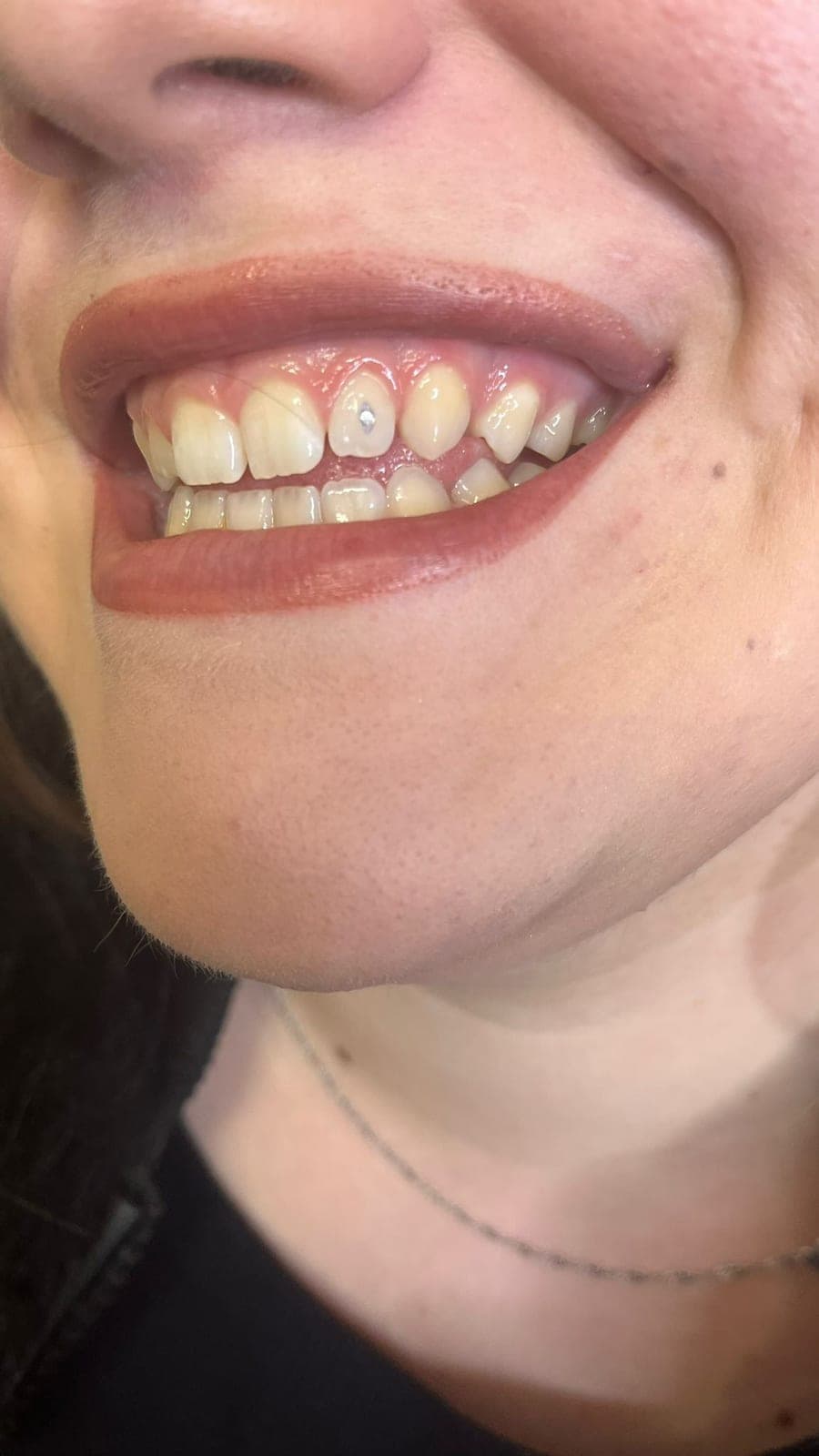 Tooth gem applicato sul dente — Golden Skin Bergamo